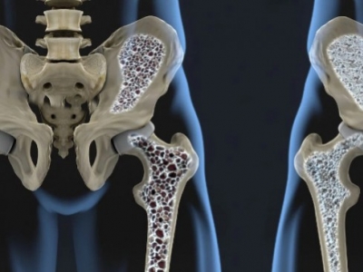 Remedio Natural para la Osteoporosis
